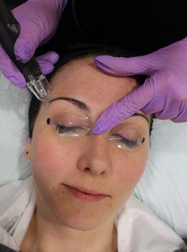 During the Microderm Treatment