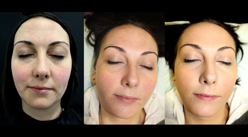 My Microderm Diary - after